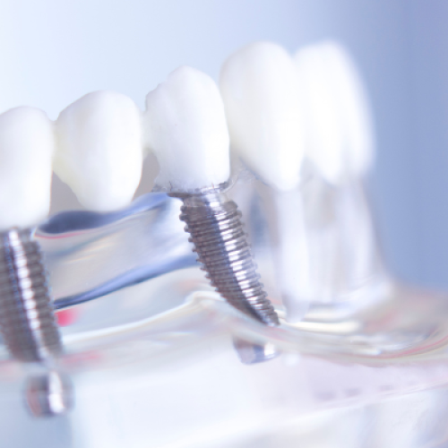 Ritrovare il sorriso: soluzioni moderne per chi cerca impianti dentali a Roma e dintorni