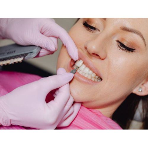 Faccette dentali estetiche Palermo