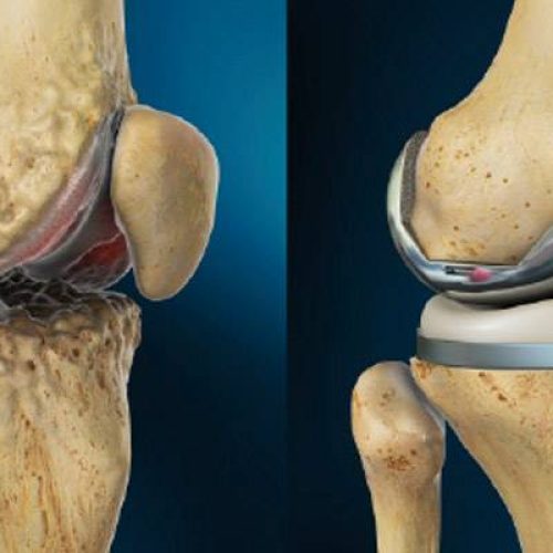 Medico specialista in chirurgia protesica del ginocchio a Torino