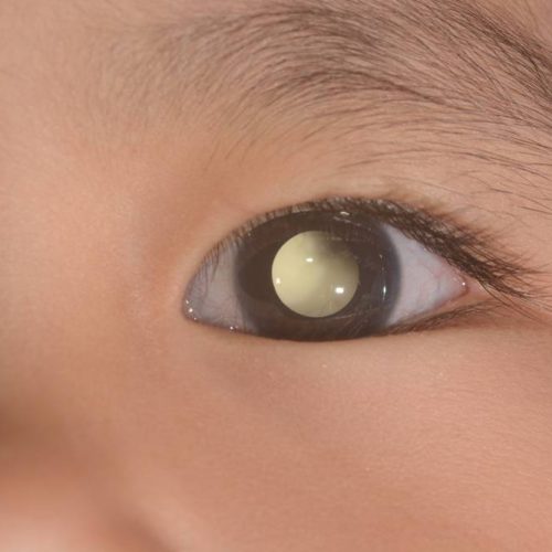 Curare Retinoblastoma a Siena