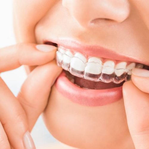 ORTODONZIA INVISIBILE SAN CIPRIANO PICENTINO